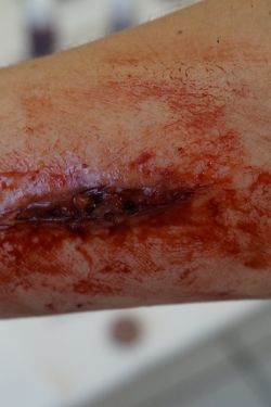 sfx - coupure infectée